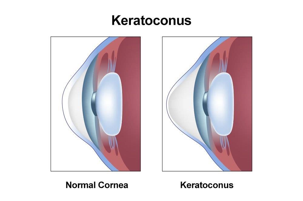 Keratoconus