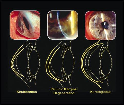Types of Irregular Corneas