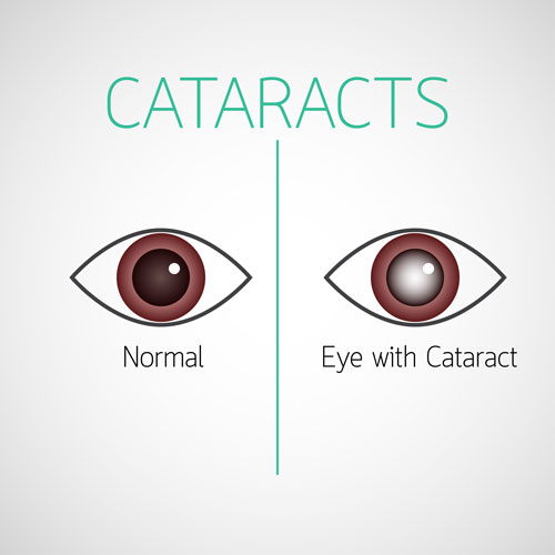 HW_CATARACT