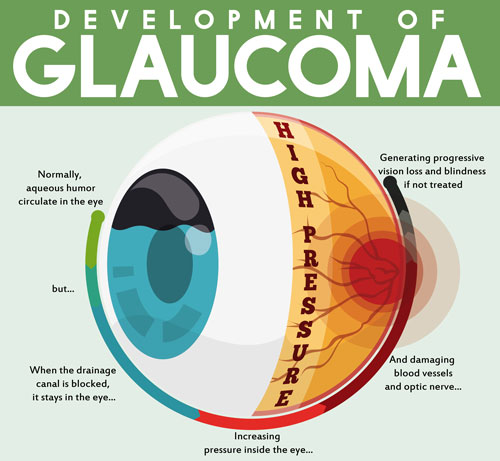 HW_GLAUCOMA